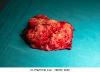 What an actual meningioma looks like 
