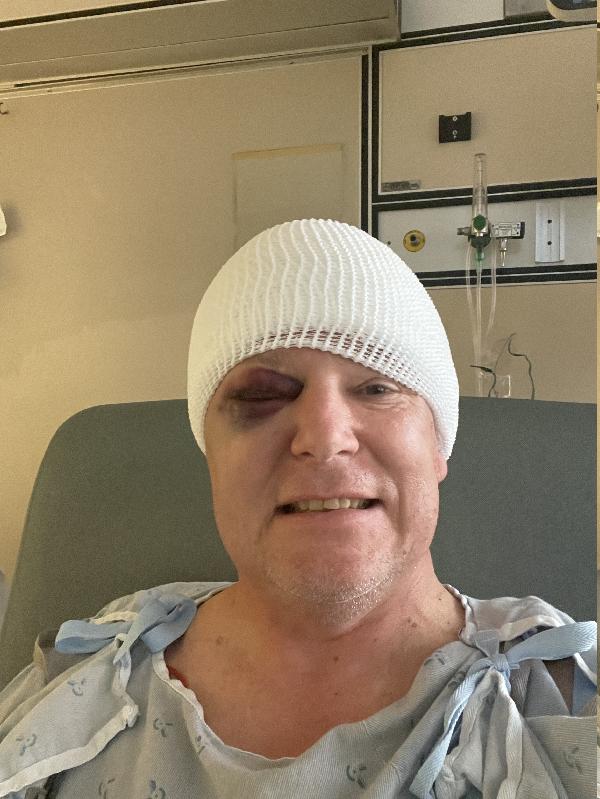 Day after surgery. Big black eye! 