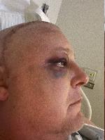 Black eye starting to heal up. Still two days post-op. 