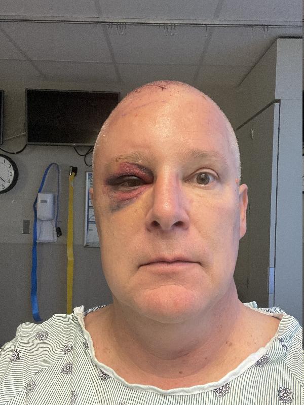 Looking pretty good. Three days post op. 