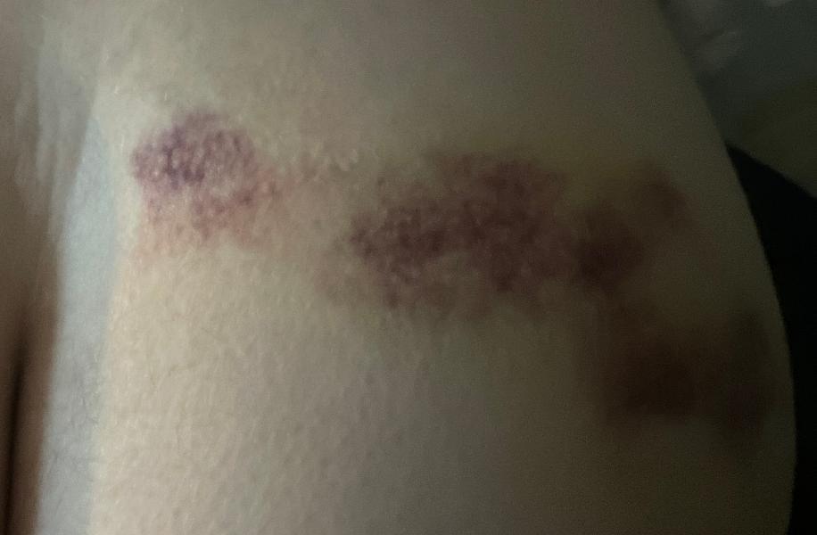 I think these are the bruises where they put the IV lines in my leg. 