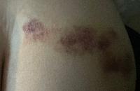 I think these are the bruises where they put the IV lines in my leg. 