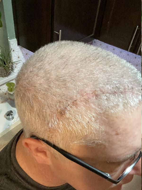 Scar nearly invisible. 