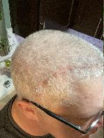 Scar nearly invisible. 