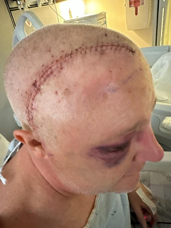 Bandages off, showing the incision 