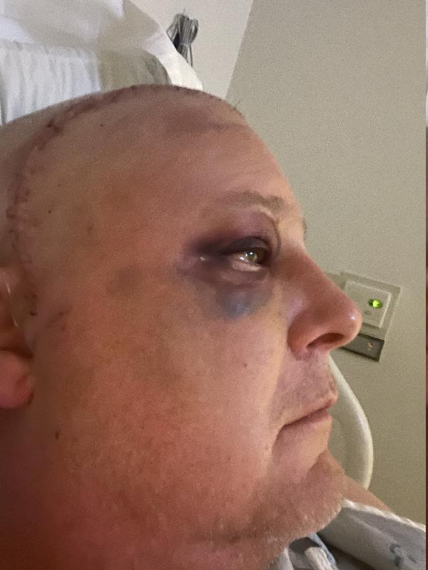 Black eye starting to heal up. Still two days post-op. 