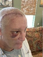 Incision healing nicely  (20231118-140931.jpg)