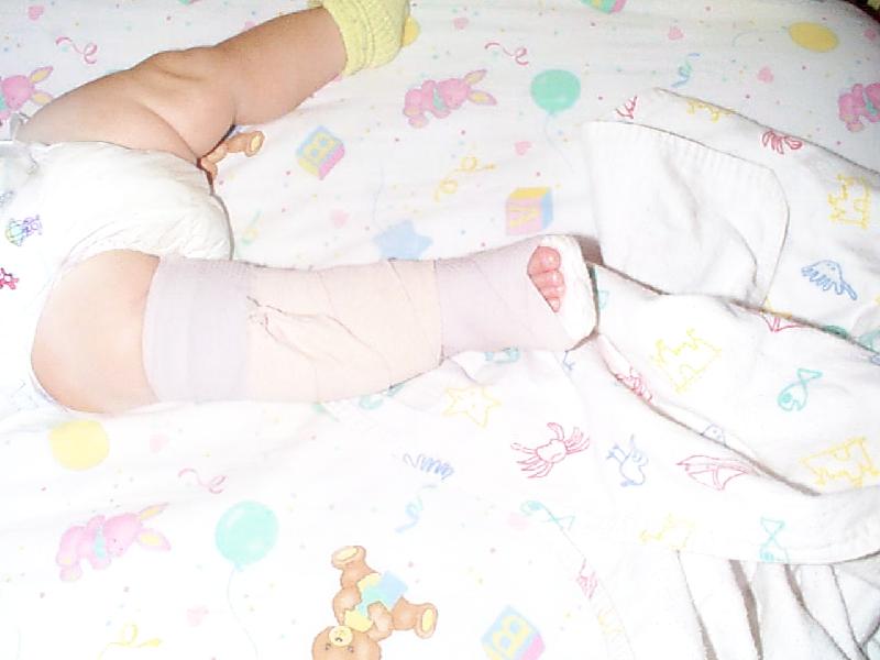 Jada splint closeup