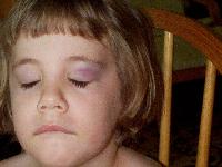 Jordan bonked into a chair and got her first black eye